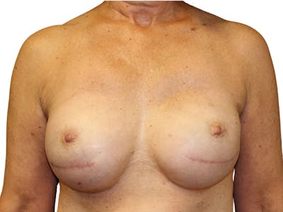 Breast Revisions Before & After Gallery - Patient 223385 - Image 1