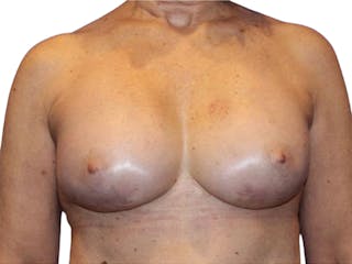 Breast Revisions Before & After Gallery - Patient 223385 - Image 2