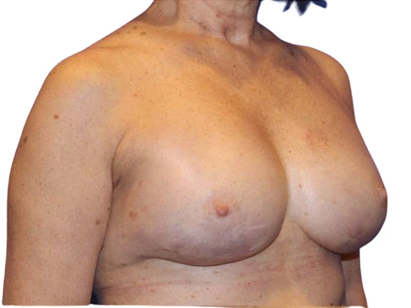 Breast Revisions Before & After Gallery - Patient 223385 - Image 4