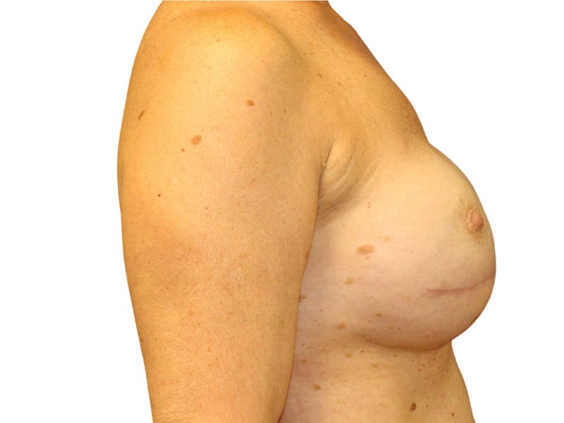 Breast Revisions Before & After Gallery - Patient 223385 - Image 5
