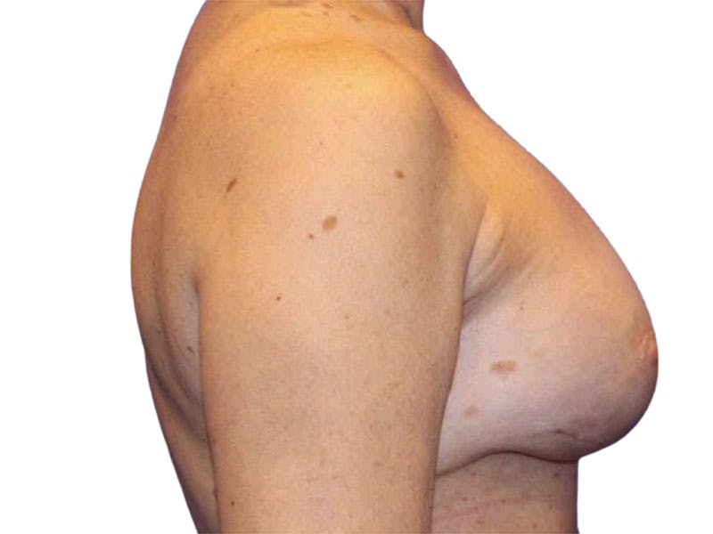 Breast Revisions Before & After Gallery - Patient 223385 - Image 6