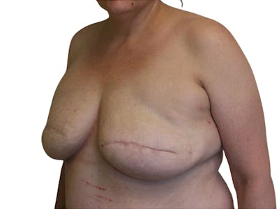 Breast Revisions Before & After Gallery - Patient 425890 - Image 1