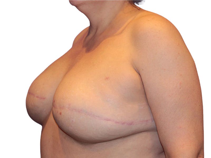 Breast Revisions Before & After Gallery - Patient 425890 - Image 2