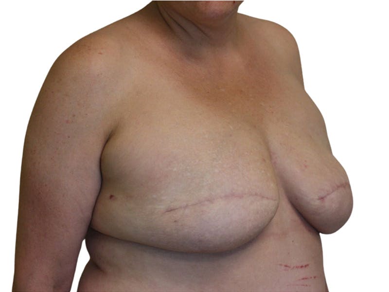 Breast Revisions Before & After Gallery - Patient 425890 - Image 3