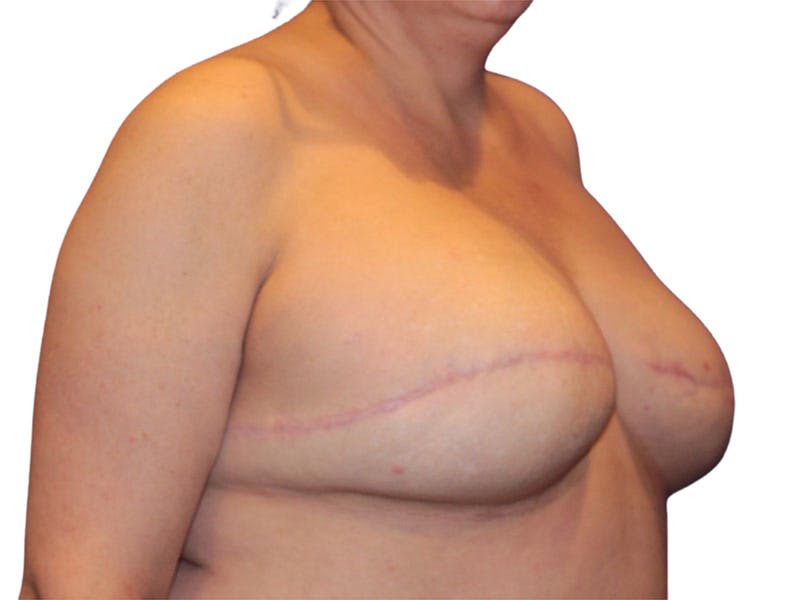 Breast Revisions Before & After Gallery - Patient 425890 - Image 4