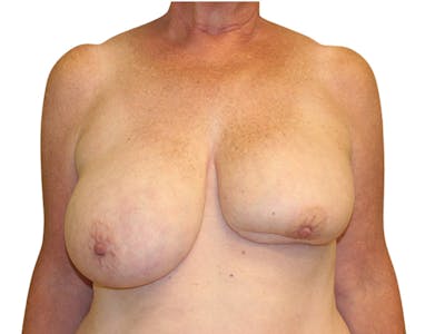 Breast Revisions Before & After Gallery - Patient 156306 - Image 1