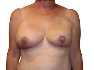 Breast Revisions Before & After Gallery - Patient 156306 - Image 2