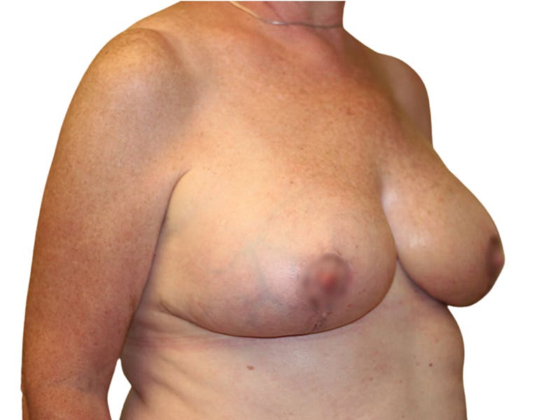 Breast Revisions Before & After Gallery - Patient 156306 - Image 4