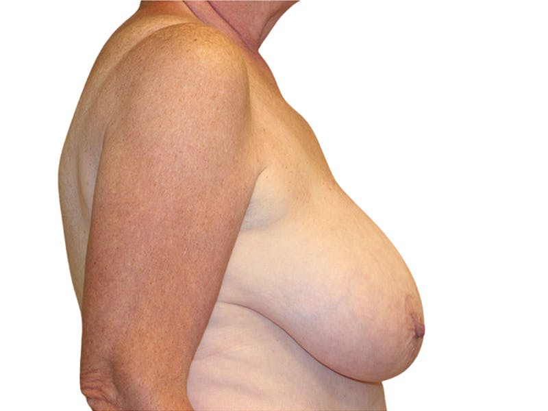 Breast Revisions Before & After Gallery - Patient 156306 - Image 5