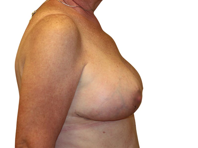 Breast Revisions Before & After Gallery - Patient 156306 - Image 6