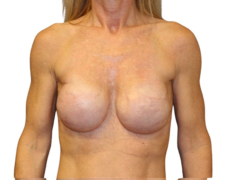Breast Revisions Before & After Gallery - Patient 323901 - Image 2