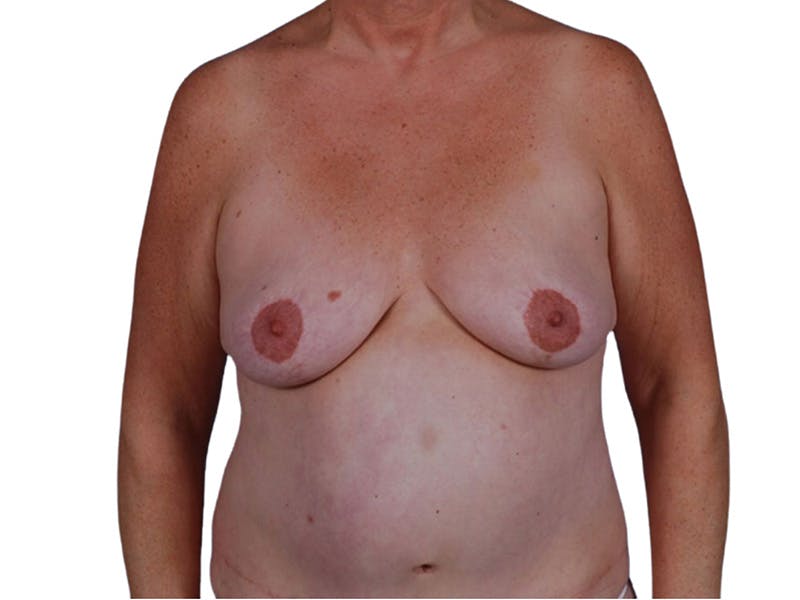 Breast Revisions Before & After Gallery - Patient 206177 - Image 1