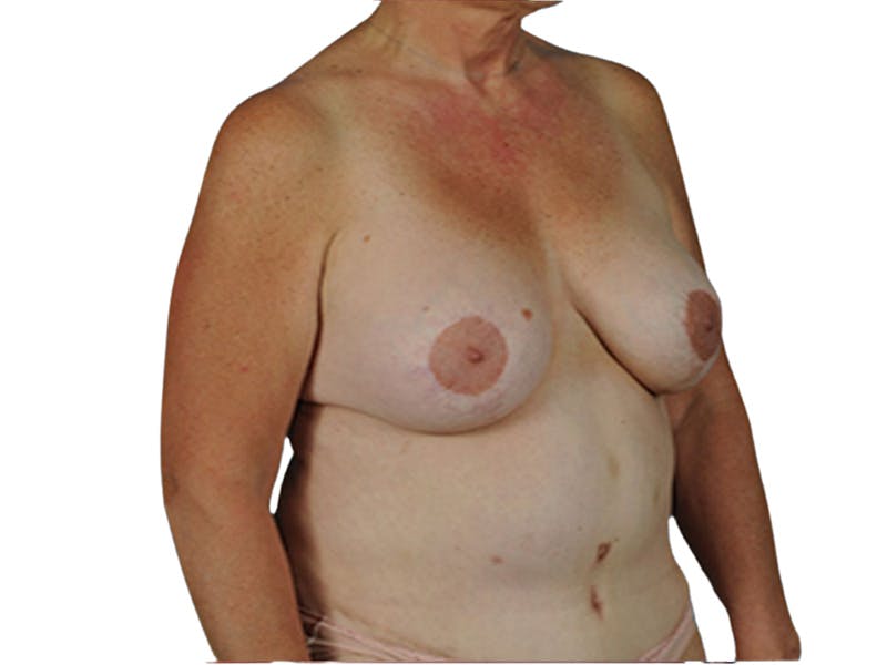 Breast Revisions Before & After Gallery - Patient 206177 - Image 4