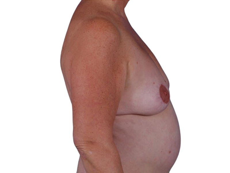 Breast Revisions Before & After Gallery - Patient 206177 - Image 5