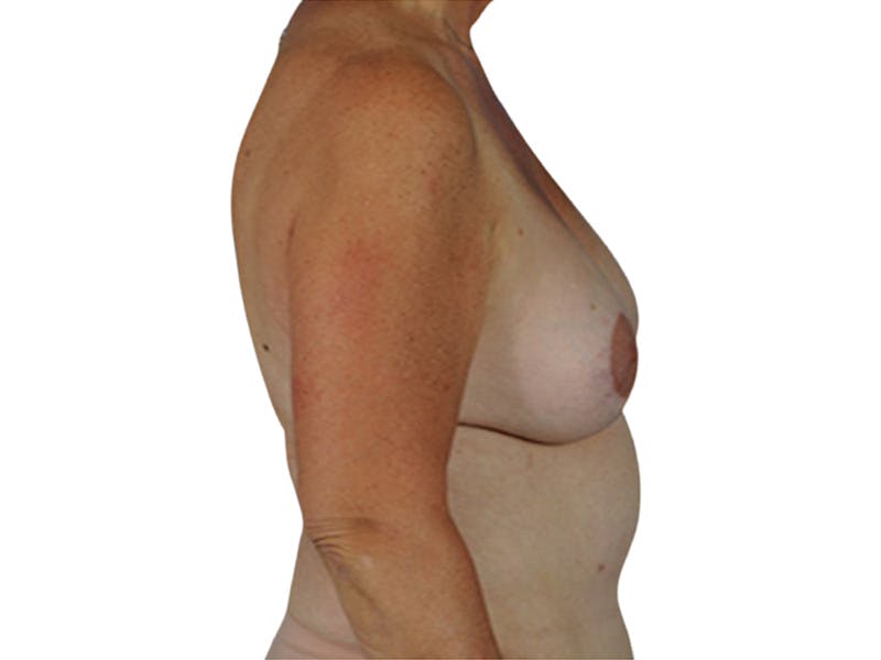 Breast Revisions Before & After Gallery - Patient 206177 - Image 6