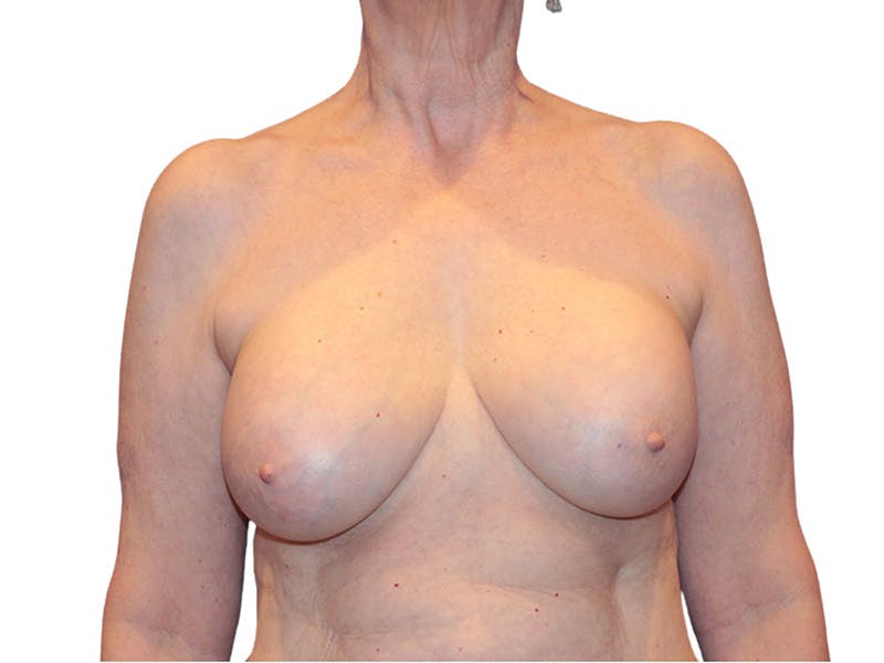 Breast Revisions Before & After Gallery - Patient 413065 - Image 1