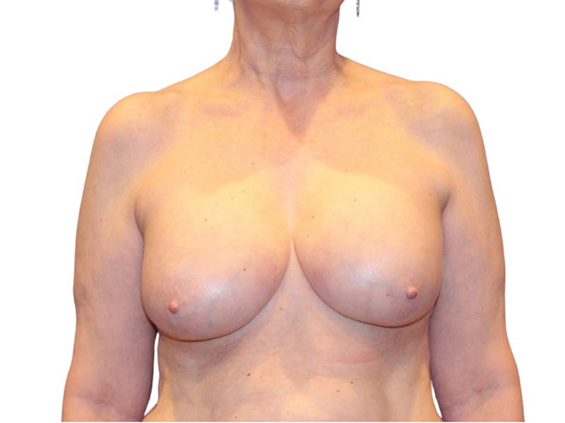 Breast Revisions Before & After Gallery - Patient 413065 - Image 2