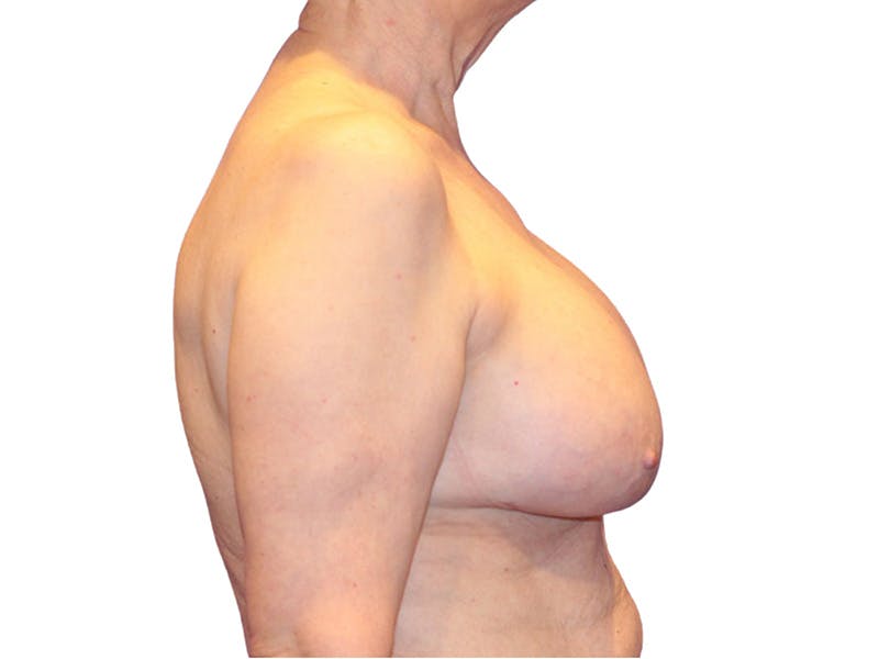 Breast Revisions Before & After Gallery - Patient 413065 - Image 5