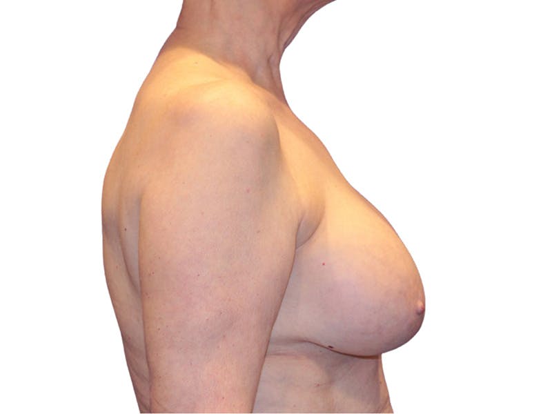Breast Revisions Before & After Gallery - Patient 413065 - Image 6