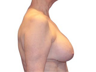 Breast Revisions Before & After Gallery - Patient 413065 - Image 6