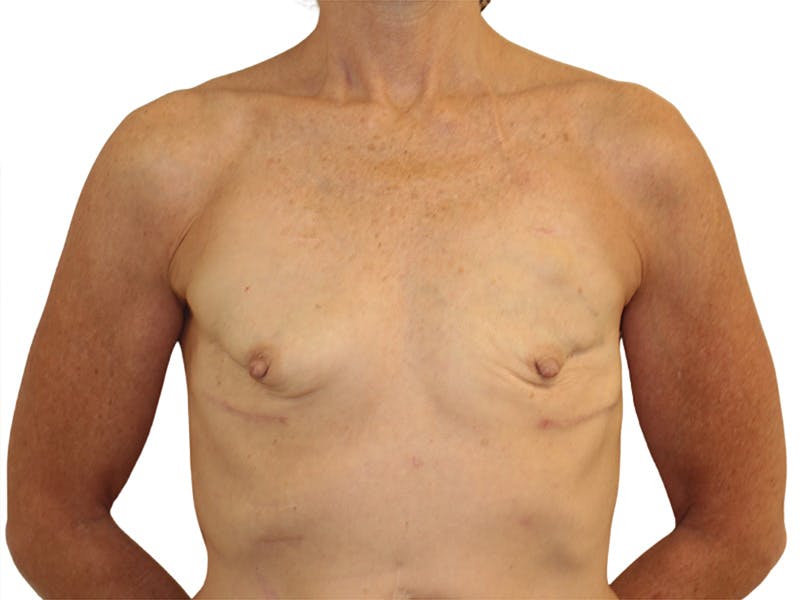 Breast Reconstruction Before & After Gallery - Patient 383985 - Image 1