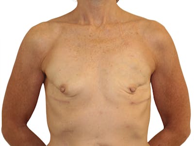 Breast Reconstruction Before & After Gallery - Patient 383985 - Image 1