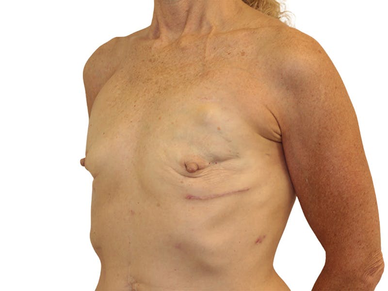 Breast Reconstruction Before & After Gallery - Patient 383985 - Image 3