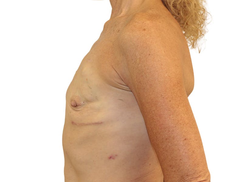 Breast Reconstruction Before & After Gallery - Patient 383985 - Image 5