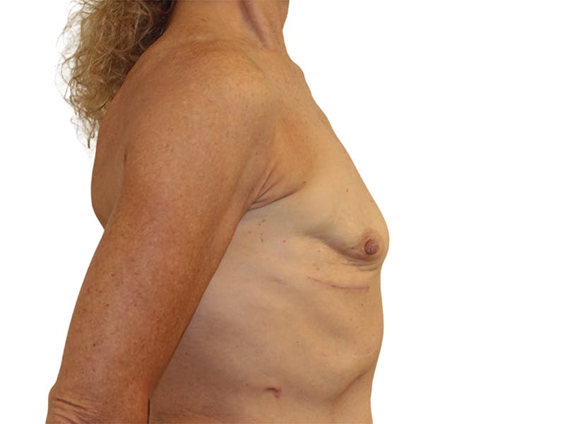Breast Reconstruction Before & After Gallery - Patient 383985 - Image 7