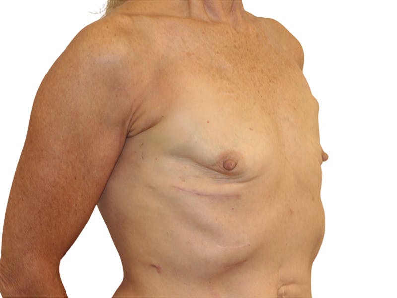 Breast Reconstruction Before & After Gallery - Patient 383985 - Image 9