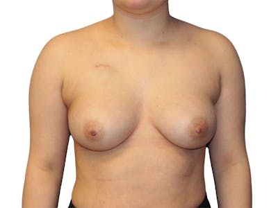 Breast Reconstruction Before & After Gallery - Patient 332144 - Image 1
