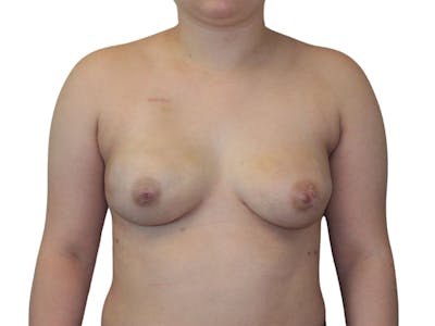 Breast Reconstruction Before & After Gallery - Patient 332144 - Image 2