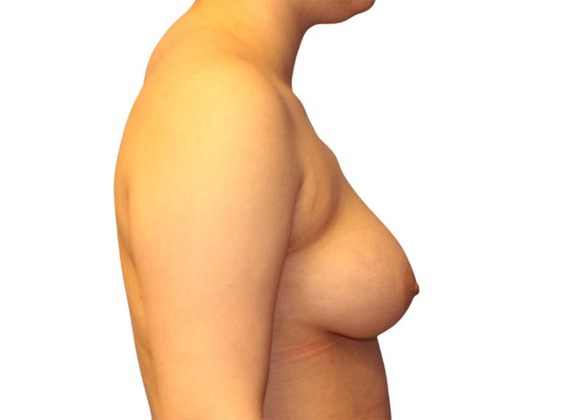 Breast Reconstruction Before & After Gallery - Patient 332144 - Image 5