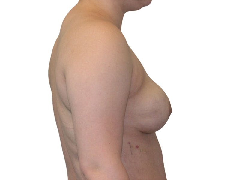 Breast Reconstruction Before & After Gallery - Patient 332144 - Image 6