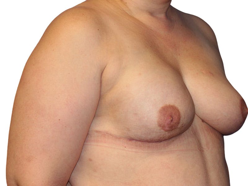 Breast Reconstruction Before & After Gallery - Patient 158681 - Image 2