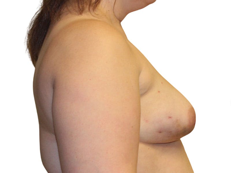 Breast Reconstruction Before & After Gallery - Patient 158681 - Image 3