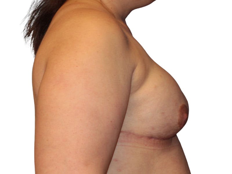 Breast Reconstruction Before & After Gallery - Patient 158681 - Image 4