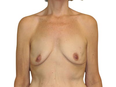 Breast Reconstruction Before & After Gallery - Patient 207496 - Image 1