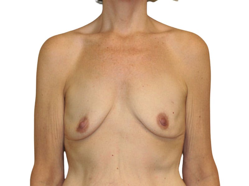 Breast Reconstruction Before & After Gallery - Patient 207496 - Image 1