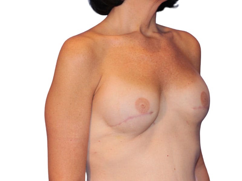 Breast Reconstruction Before & After Gallery - Patient 207496 - Image 4