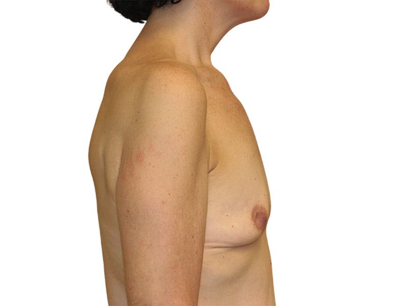 Breast Reconstruction Before & After Gallery - Patient 207496 - Image 5