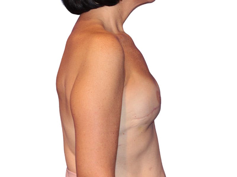 Breast Reconstruction Before & After Gallery - Patient 207496 - Image 6