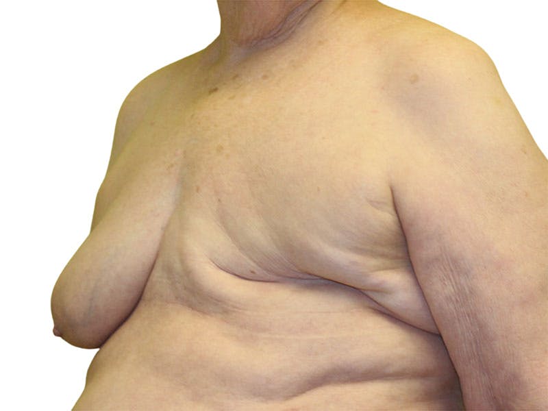 Breast Reconstruction Before & After Gallery - Patient 311044 - Image 1