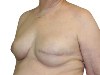 Breast Reconstruction Before & After Gallery - Patient 311044 - Image 2