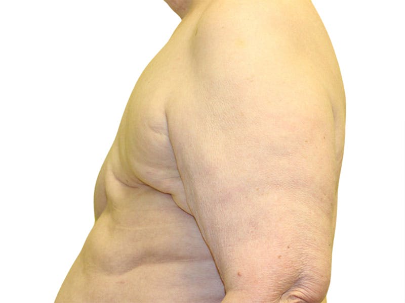 Breast Reconstruction Before & After Gallery - Patient 311044 - Image 3