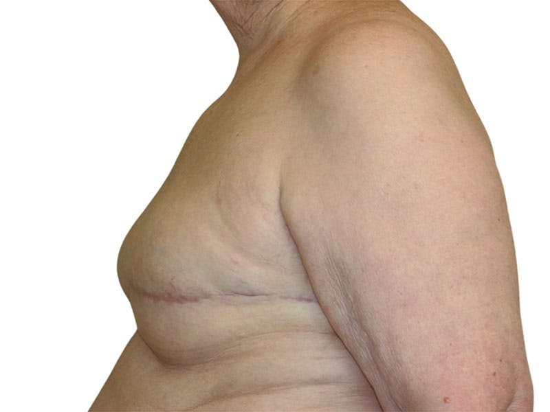 Breast Reconstruction Before & After Gallery - Patient 311044 - Image 4