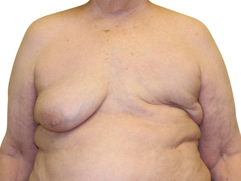 Breast Reconstruction Before & After Gallery - Patient 311044 - Image 5