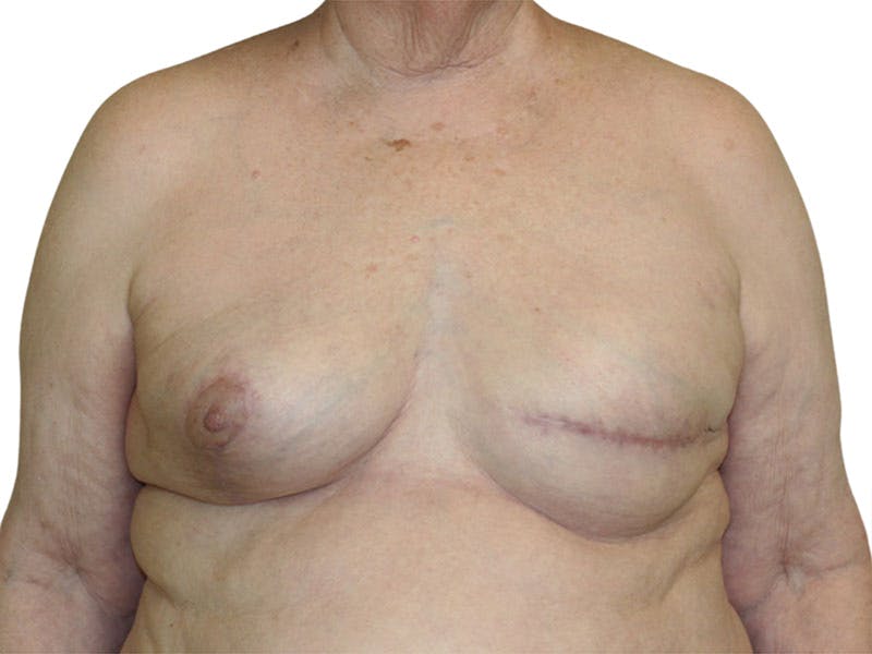 Breast Reconstruction Before & After Gallery - Patient 311044 - Image 6