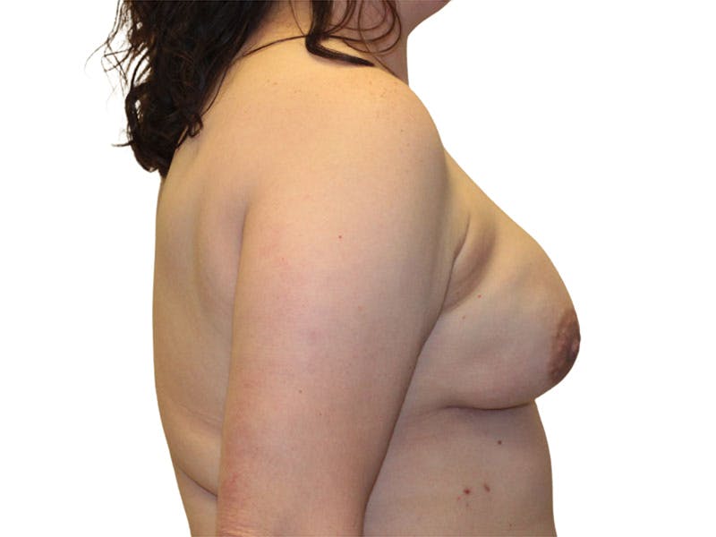 Breast Reconstruction Before & After Gallery - Patient 388737 - Image 6