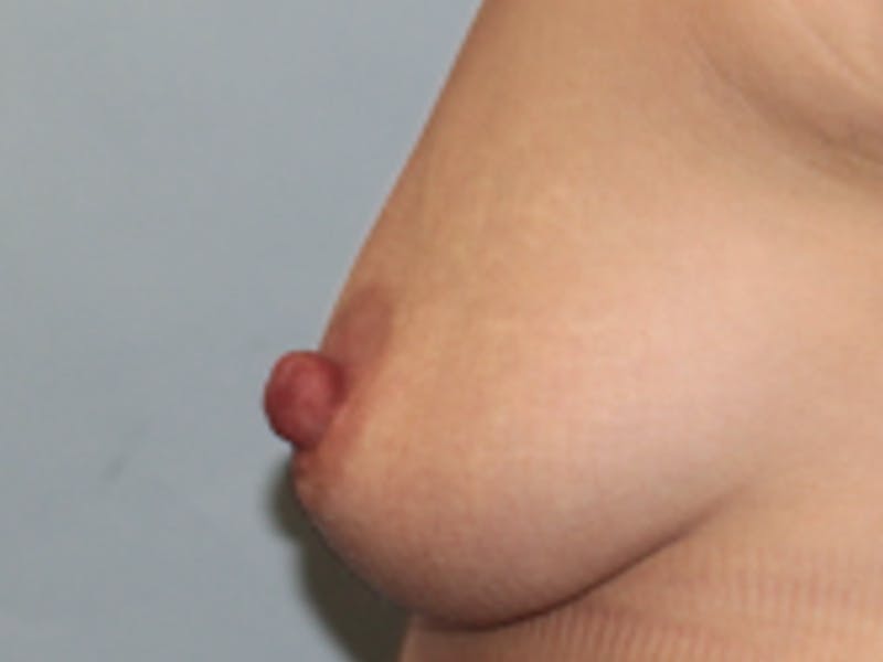 Nipple Surgery Before & After Gallery - Patient 160218 - Image 5